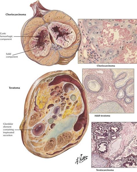 Diseases of the Male Reproductive System | Clinical Gate