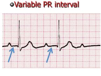 Step 4 PR interval (PRi) - EKG Lesson #318