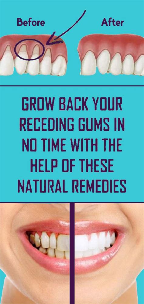 Treat Receding Gums Naturally Using These Methods - Home Remedies