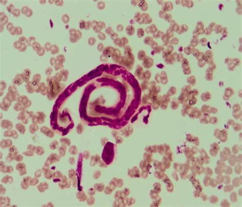 Note the presence of spiral microfilaria worm in blood smear [Giemsa X ...