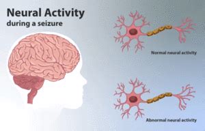 Subacute Sclerosing Panencephalitis - Physiopedia