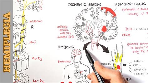 Hemiplegia part 1 - causes, pathophysiology, stages and manifestations - YouTube