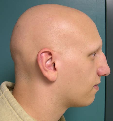 Alopecia Totalis - Symptoms, Causes and Treatment