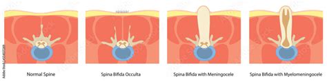 Spina Bifida illustration in a Cross view. normal spine, meningocele ...