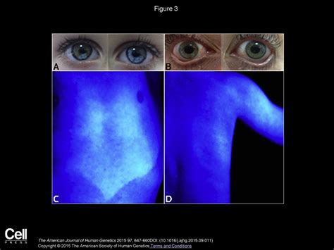 Allelic Mutations of KITLG, Encoding KIT Ligand, Cause Asymmetric and Unilateral Hearing Loss ...