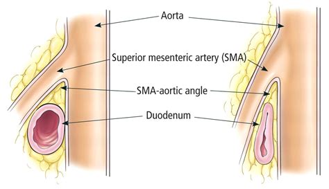 SMA SYNDROME - 3rd part of duodenum sandwiched by SMA and Abdom Aorta ->… | Superior mesenteric ...