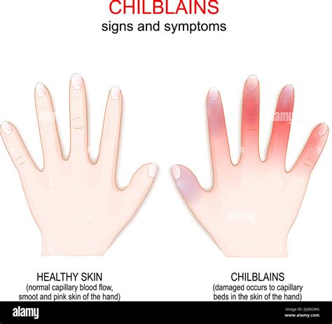 Chilblain Lesions