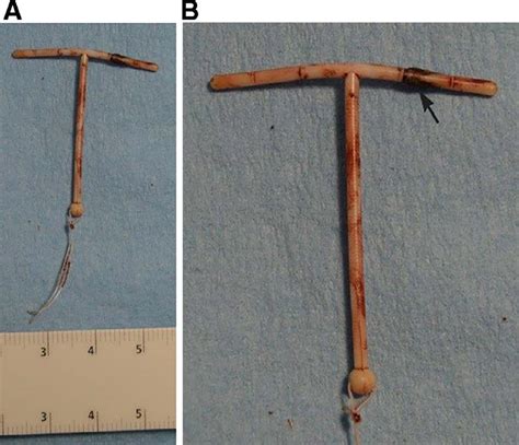 -(A) Photograph of the removed IUD shows intact strings. (B) Zoomed ...