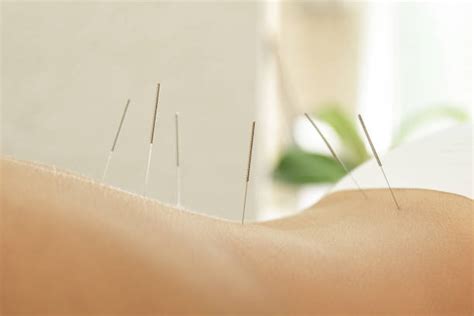 1,600+ Acupuncture Needles On Back Stock Photos, Pictures & Royalty ...