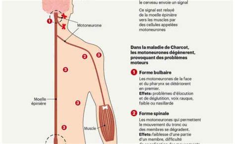 Maladie De Charcot Maladie De Charcot Causes Et Traitement Pour – Otosection