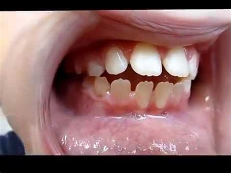 Tongue Thrust Video, Myofunctional Therapist - YouTube