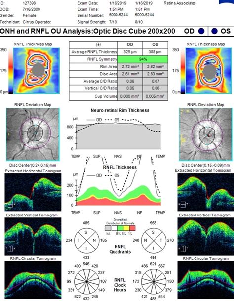 OCT in Patient With IIH Showing Thickened RNFL - Retina Image Bank