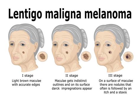 Lentigo Maligna and Lentigo Maligna Melanoma: Causes, Symptoms and Treatment