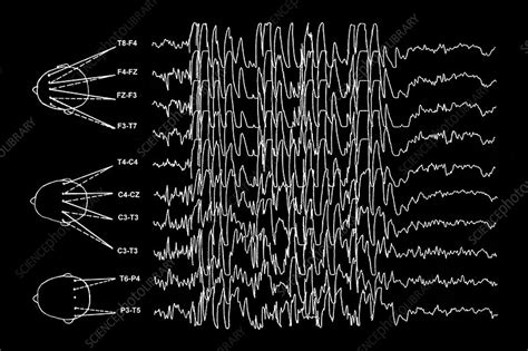 Brain waves in epilepsy - Stock Image - M150/0280 - Science Photo Library