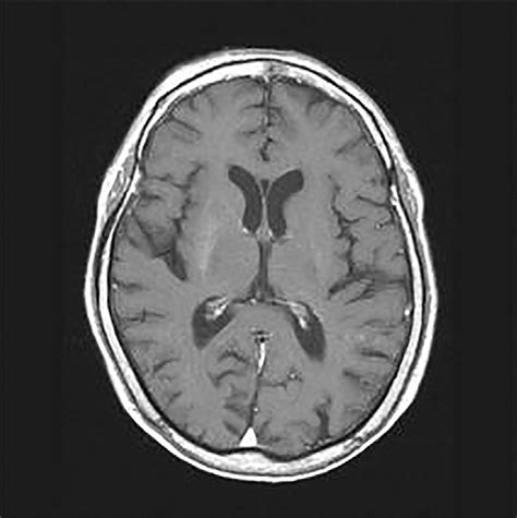 Figure.Hyperintensity over right basal ganglia on T1- weighted MRI ...