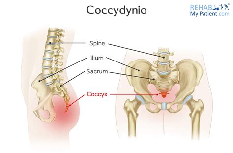 Coccydynia | Rehab My Patient