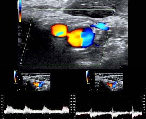 Arterial Doppler Ultrasound