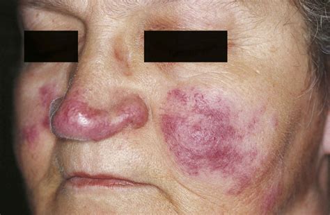 Lupus pernio causes, symptoms, diagnosis, treatment & prognosis