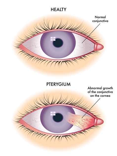 Pterygium Specialists | Surfer's Eye Long Beach - SoCal Eye