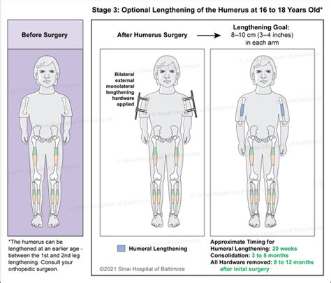 Dwarfism - International Center for Limb Lengthening