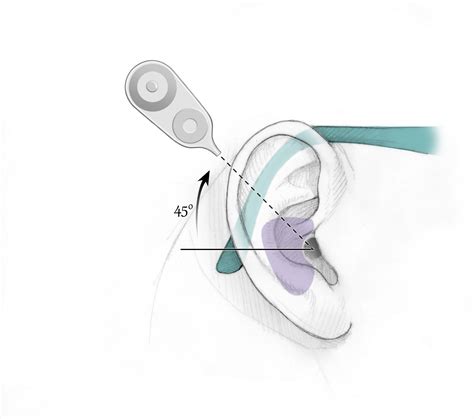 Cochlear Implant Surgery