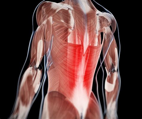 Breaking Down Multifidus Muscle Pain: Causes and Symptoms