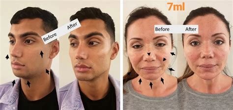 Facial Contouring: Beautification and Masculinization - Your Health Magazine