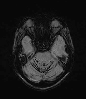 Superficial Siderosis : Importance of Susceptibility MRI Imaging - Blogs