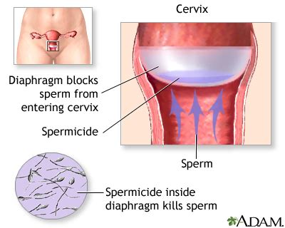 Barrier methods of birth control - series—Diaphragm: MedlinePlus Medical Encyclopedia