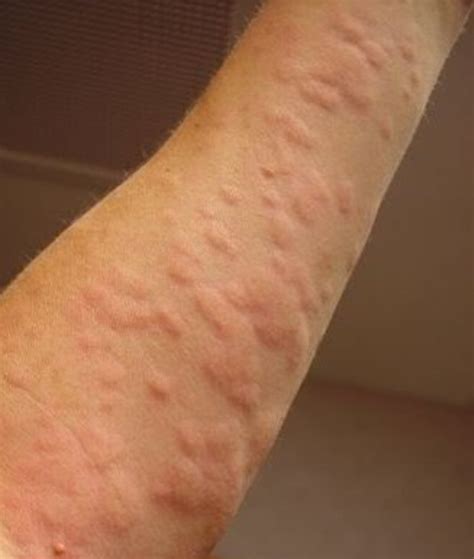 How Can You Get Hives — Natural Remedies | HubPages