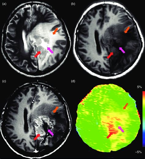 MRI in a patient with recurrent astrocytoma (grade III), acquired 4 ...