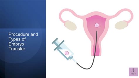 Embryo Transfer: Procedure and Types