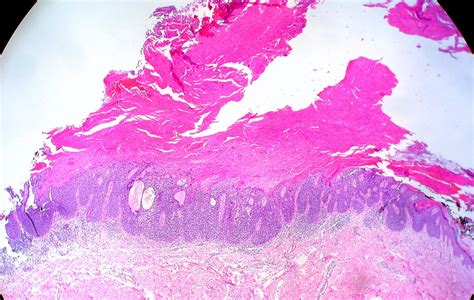 Squamous Carcinoma in Situ with Cutaneous Horn | Ed Uthman | Flickr