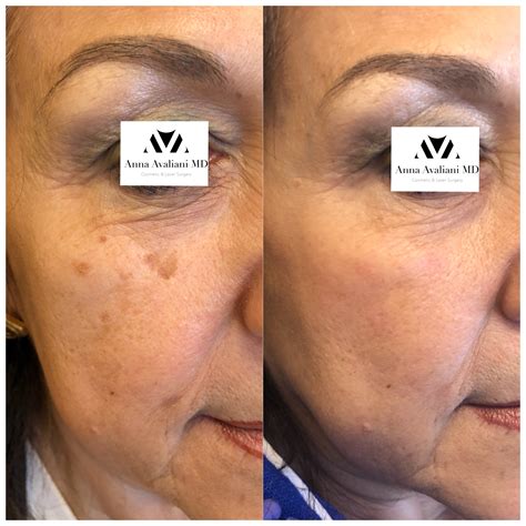 Best Melasma treatment on the market is PicoSure Focus! - Anna Avaliani MD - Cosmetic & Laser ...