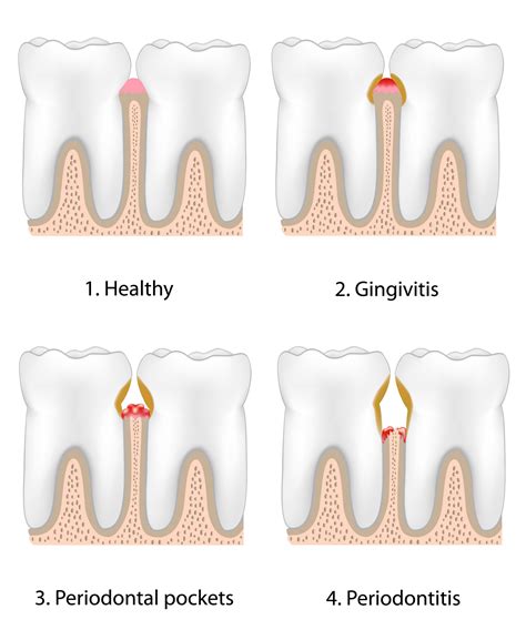 Stages of Gum Disease - Lake Jackson, TX - Bell Dental