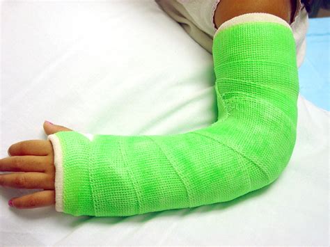 Elbow Fracture Cast