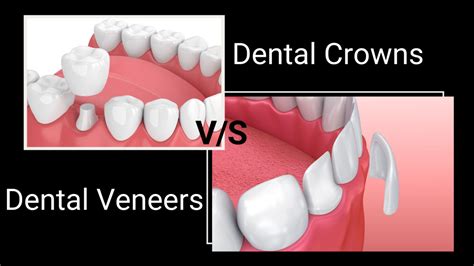 What is the Difference Between Dental Crowns and Dental Veneers?