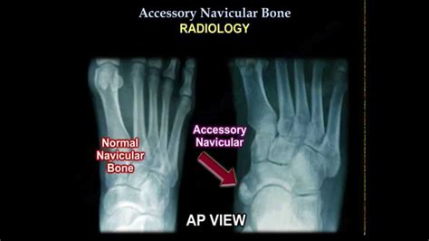 Accessory Navicular Bone - Everything You Need To Know - Dr. Nabil ...