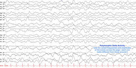 EEG Terminology and Waveforms