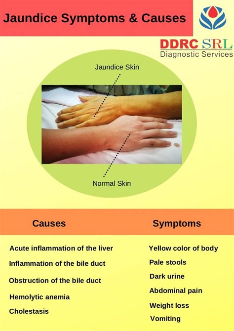 Jaundice Symptoms & Causes