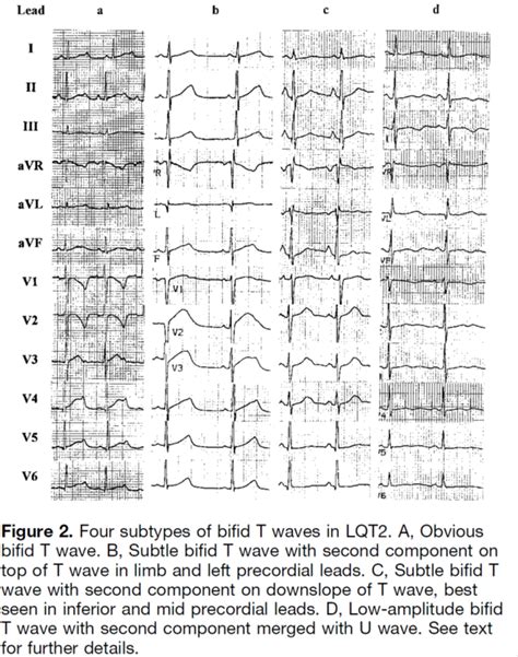 Pedi cardiology: LQTS - Type Recognition by T wave Morphology