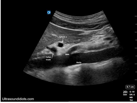 Aorta Anatomy Ultrasound