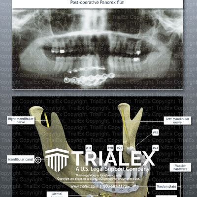 Surgical Fixation of Mandibular Fracture - TrialExhibits Inc.