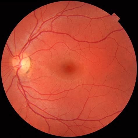 Retinal Exams - New Optix Optometry