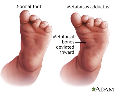 Metatarsus adductus Information | Mount Sinai - New York