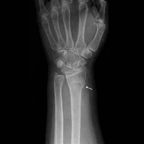 An x-ray showing left distal radius fracture of the patient (arrow). | Download Scientific Diagram