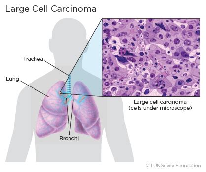 Small Cell Lung Cancer Histology