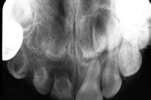 Regional Odontodysplasia – Dr. G's Toothpix