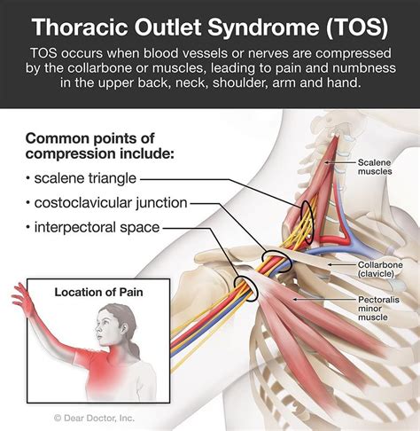 Thoracic Outlet Syndrome | Chiropractor in Wilmington, NC | Galligan Family Chiropractic