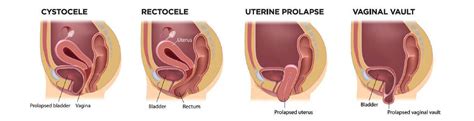 Uterine Prolapse Pregnancy